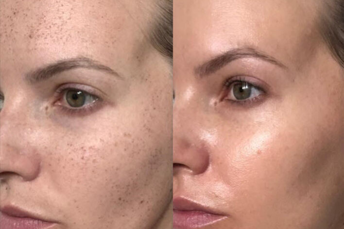 1540 Fractional Laser Before and After | Vina Laser Med Spa
