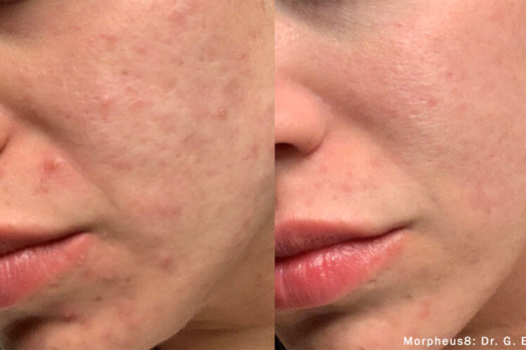 Acne Scar Laser Treatment | Vina Laser Med Spa