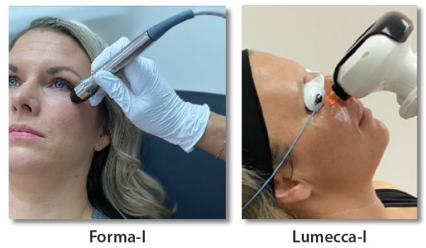 Dry Eye Laser Treatment | Vina Laser Med Spa