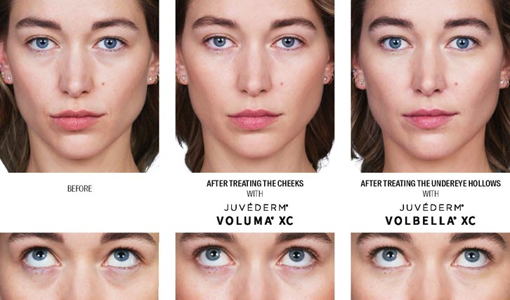 Everything You Need to Know About Juvéderm | Vina Laser Med Spa | Saginaw, Michigan