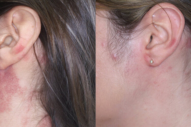 Intense Pulsed Light Therapy | Vina Laser Med Spa
