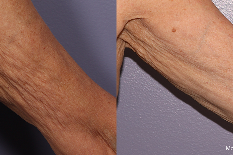 Morpheus8 Inmode Laser | Vina Laser Med Spa