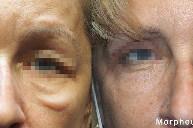 Morpheus8 Skin Tightening Laser | Vina Laser Med Spa