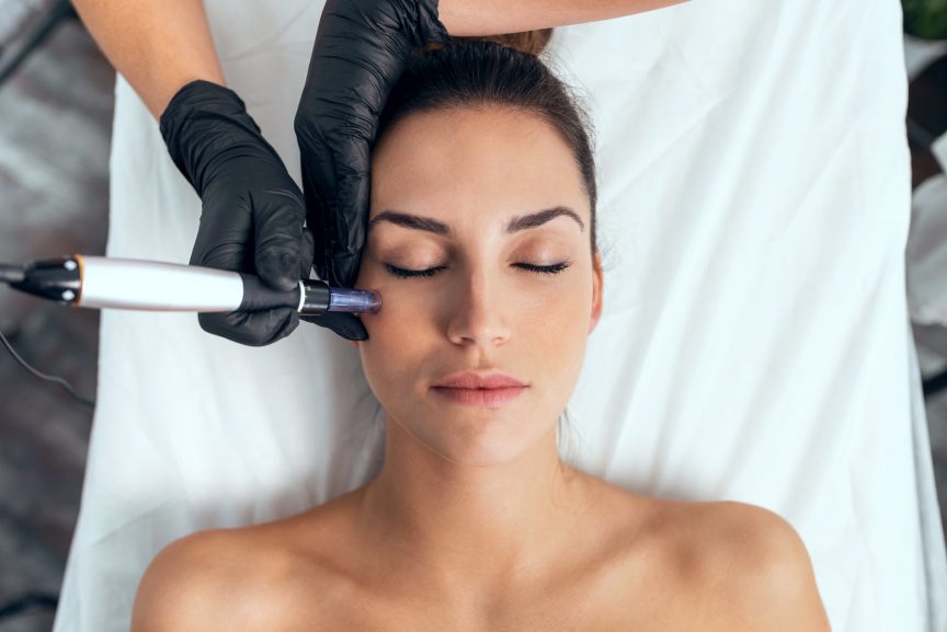 Rejuvenate Your Skin with Microneedling | Vina Laser Med Spa