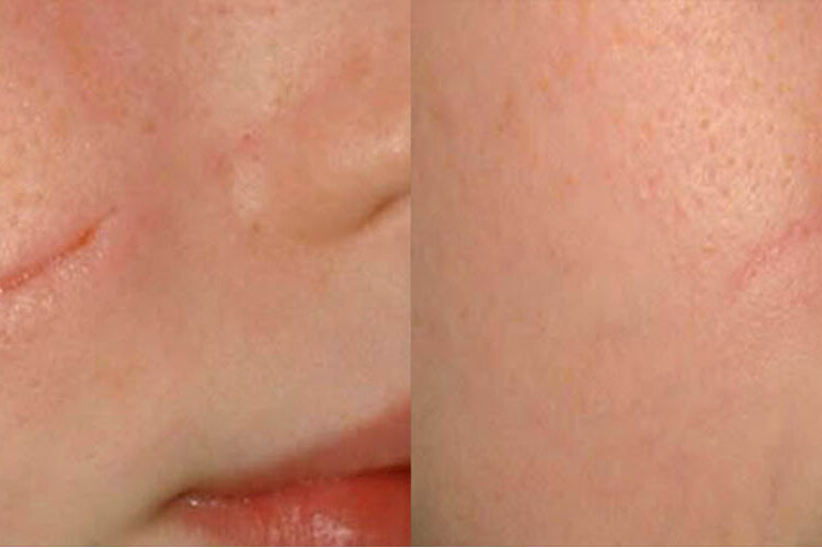 Scar Laser Removal Vina Laser Med Spa