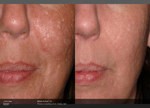 Scar Removal Before and After VINA Laser Med Spa Saginaw MI