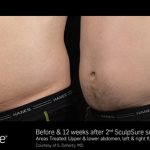 SculpSure Abdomen Before and After VINA Laser Med Spa Saginaw