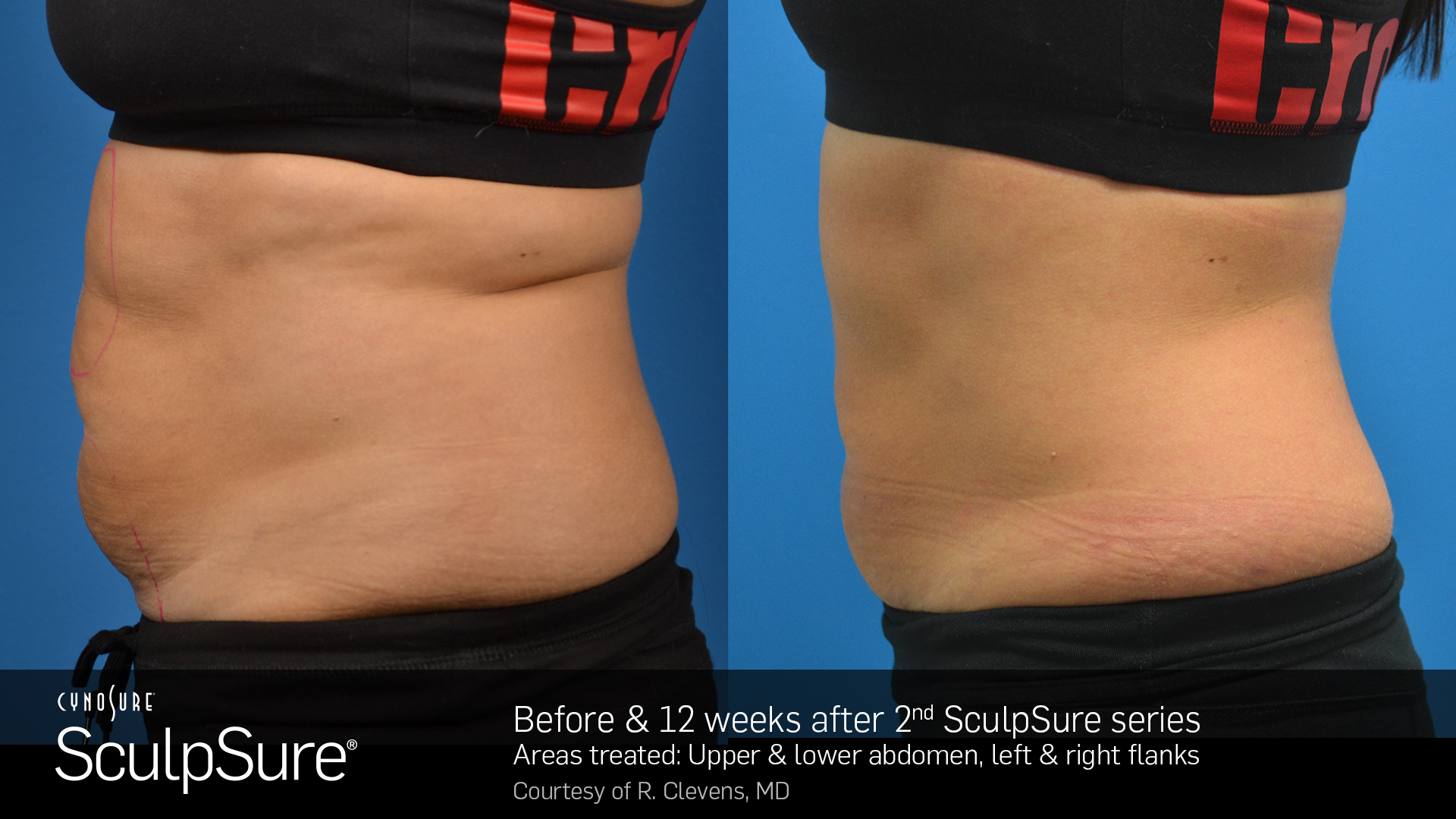 SculpSure Abdomen Before and After VINA Laser Med Spa Saginaw