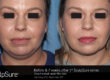 SculpSure Chin shaping vina laser med spa