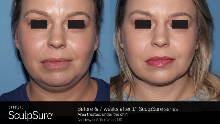 SculpSure Chin shaping vina laser med spa