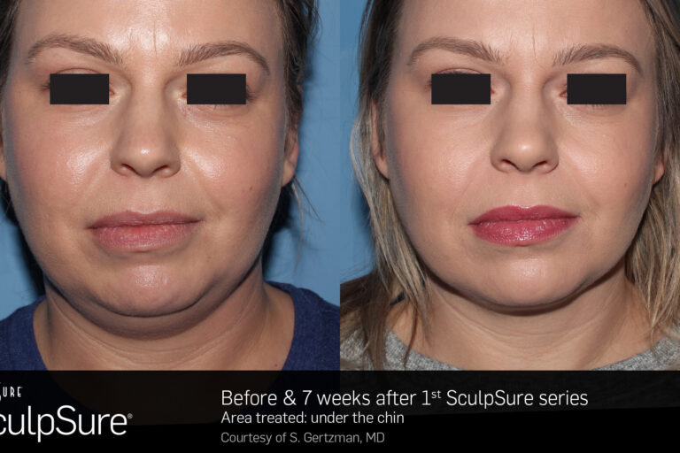 SculpSure Chin shaping vina laser med spa