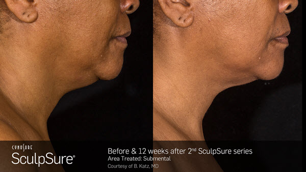 SculpSure Chin Before and After VINA Laser Med Spa Saginaw