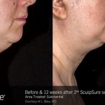 SculpSure Chin Before and After VINA Laser Med Spa Saginaw