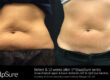 SculpSure Frequently Asked Questions | Vina Laser Med Spa