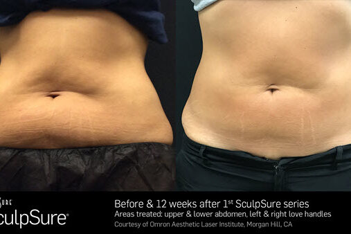 SculpSure Frequently Asked Questions | Vina Laser Med Spa