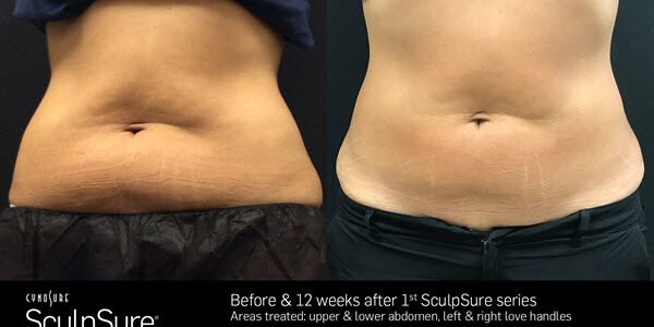 SculpSure Frequently Asked Questions | Vina Laser Med Spa