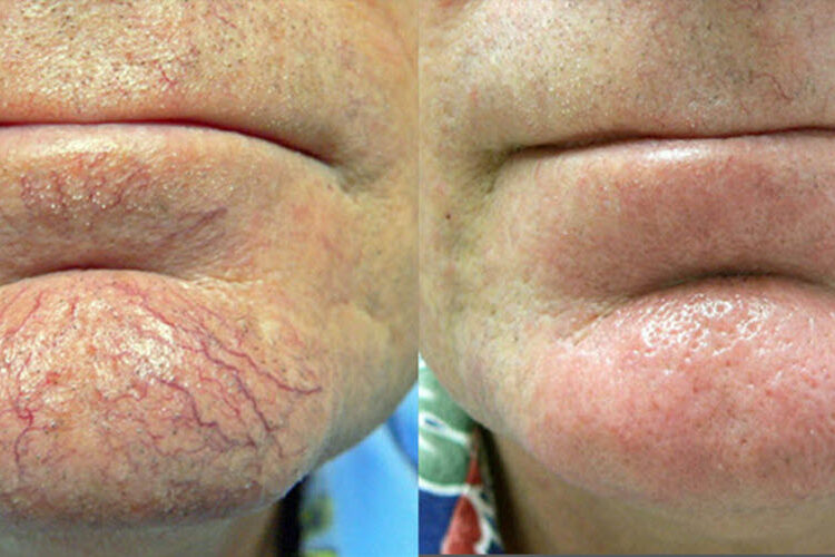 Skin Revitalization Before & After | Vina Laser Med Spa