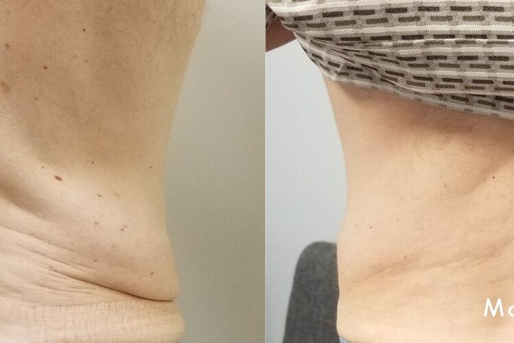 Skin Tightening | Vina Laser Med Spa