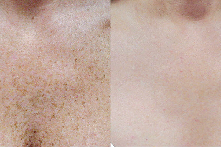 Skin Tightening Treatment | Vina Laser Med Spa