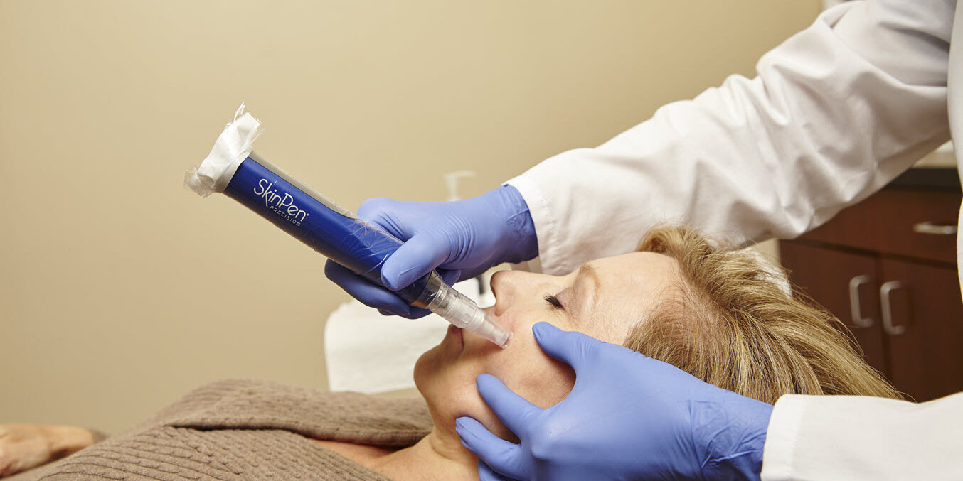 SkinPen Microneedling - 7 Things You Need to Know | Vina Laser Med Spa