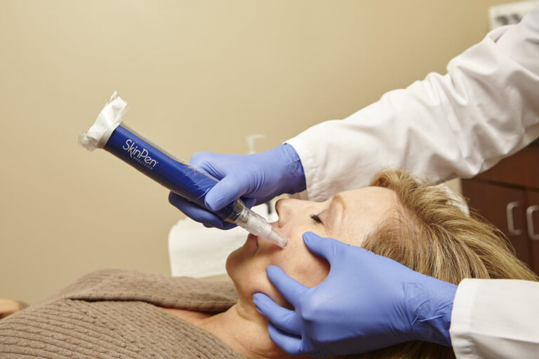 SkinPen Microneedling - 7 Things You Need to Know | Vina Laser Med Spa