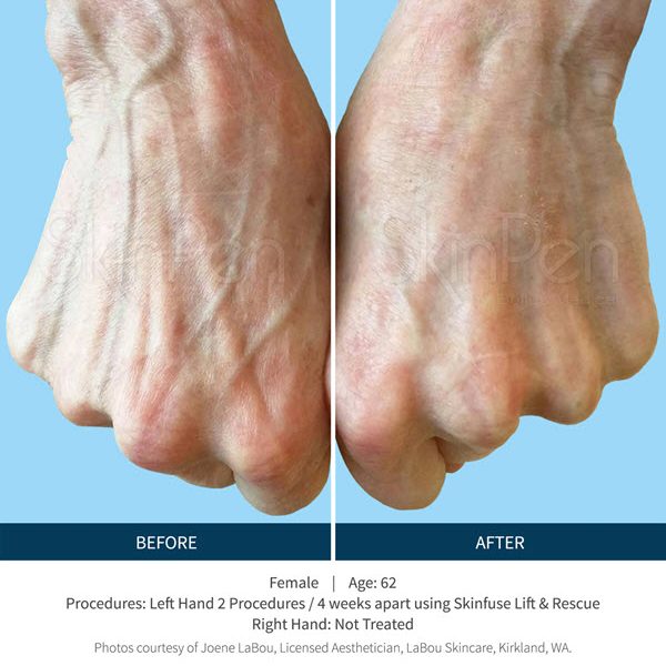 SkinPen Microneedling VINA Laser Med Spa Saginaw MI