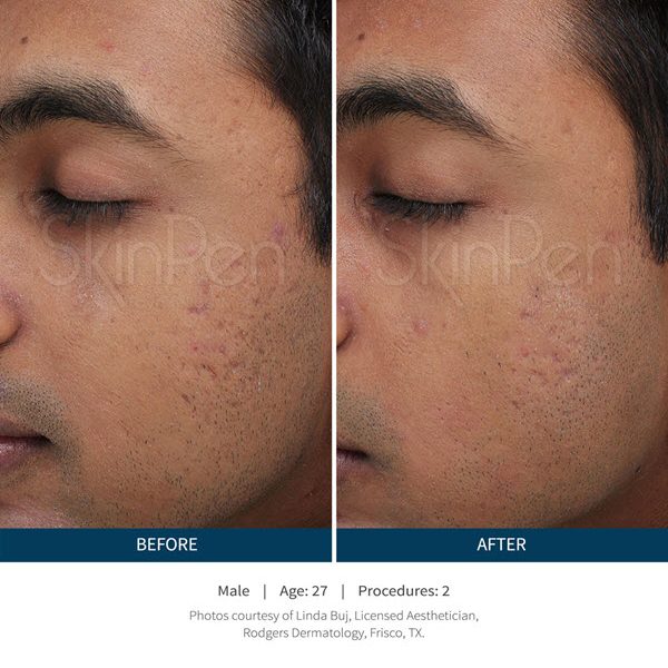 SkinPen Microneedling VINA Laser Med Spa Saginaw MI