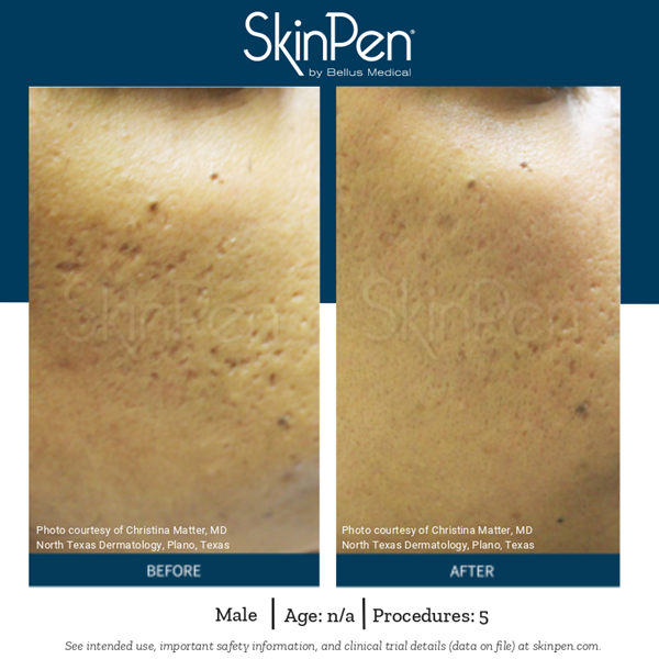 SkinPen Microneedling VINA Laser Med Spa Saginaw MI