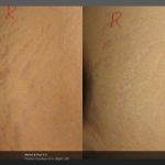 Stretch Mark Before and After VINA Laser Med Spa Saginaw MI