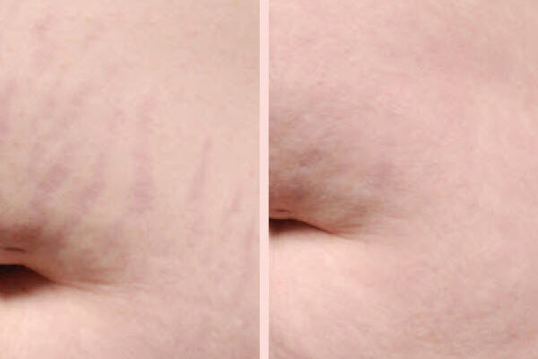 Stretch Mark Removal Saginaw | Vina Laser Med Spa
