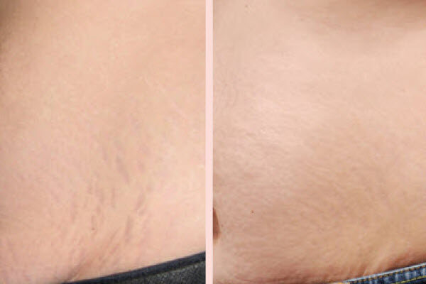 Stretch Mark Removal Saginaw | Vina Laser Med Spa