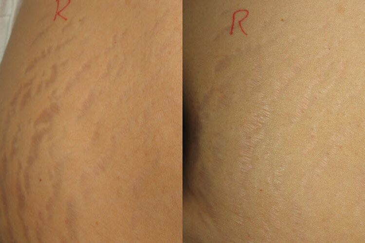 Stretch Mark Removal Vina Laser Med Spa