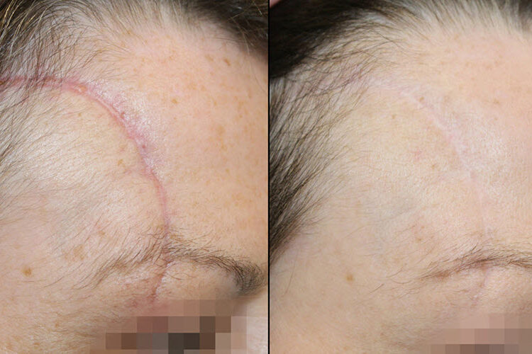 The Cynosure Icon 1540 Fractional Laser | Vina Laser Med Spa