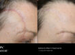 The Cynosure Icon 1540 Fractional Laser | Vina Laser Med Spa