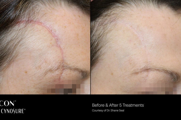 The Cynosure Icon 1540 Fractional Laser | Vina Laser Med Spa