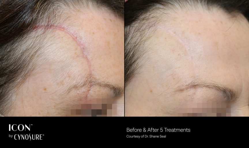 The Cynosure Icon 1540 Fractional Laser | Vina Laser Med Spa