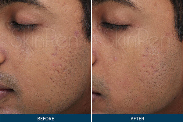 SkinPen Microneedling Saginaw, Michigan | Vina Laser Med Spa
