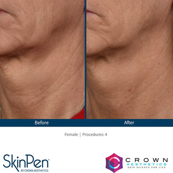 Microneedling Saginaw, Michigan | Vina Laser Med Spa