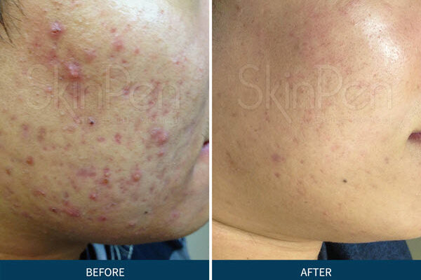 Microneedling for Acne Scars | Saginaw, Michigan | Vina Laser Med Spa