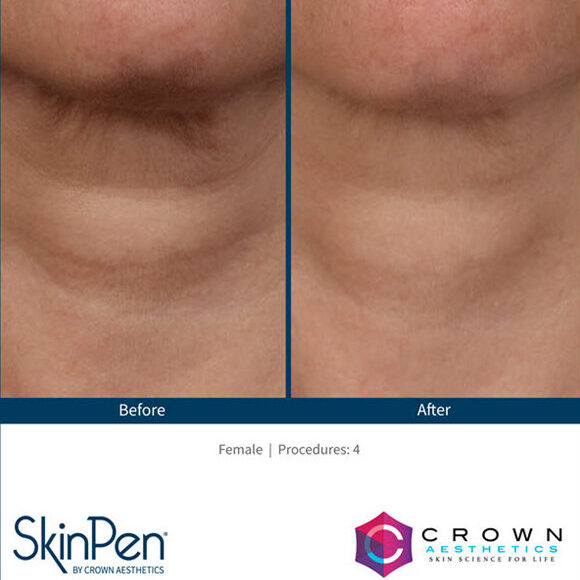 Microneedling for Neck Wrinkles | Saginaw, Michigan | Vina Laser Med Spa