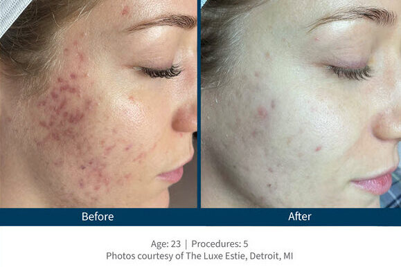 Microneedling SkinPen Vina Laser Med Spa