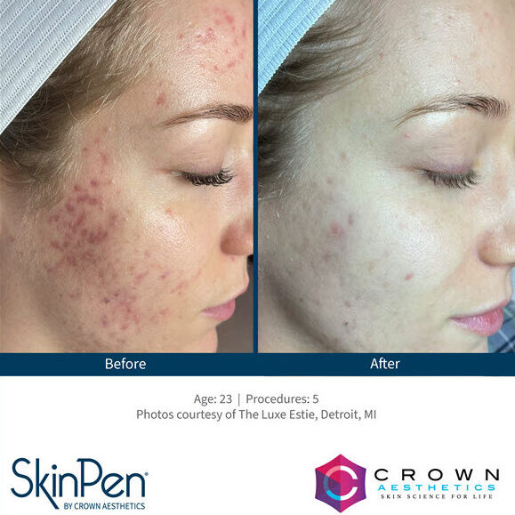 Microneedling SkinPen Vina Laser Med Spa