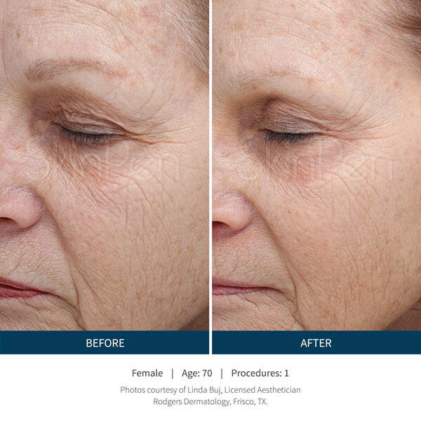 SkinPen Microneedling Saginaw, Michigan | Vina Laser Med Spa